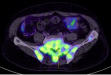 Updates in kidney cancer, bladder cancer and prostate cancer treatment, ASCO 2018